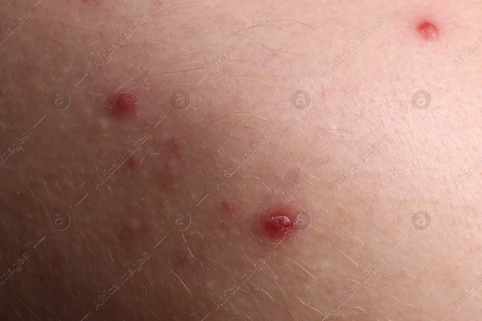 Photo of Young person with acne problem, closeup view of skin