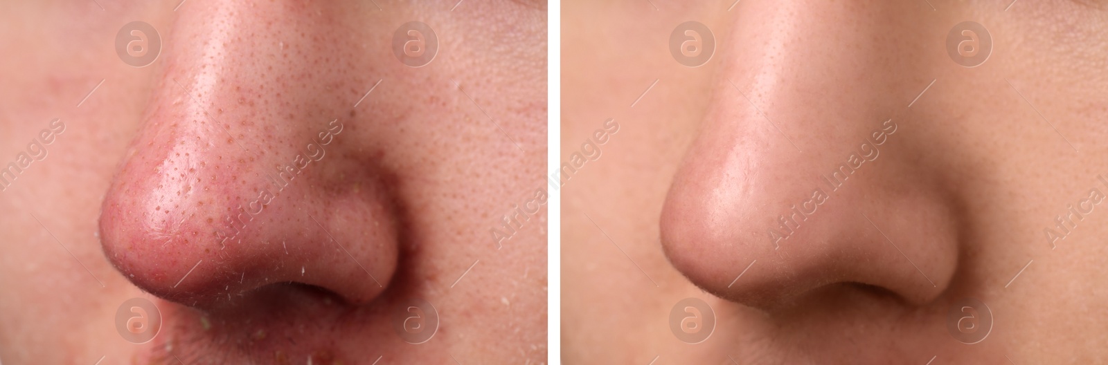 Image of Photos of man before and after acne treatment, closeup. Collage showing affected and healthy skin