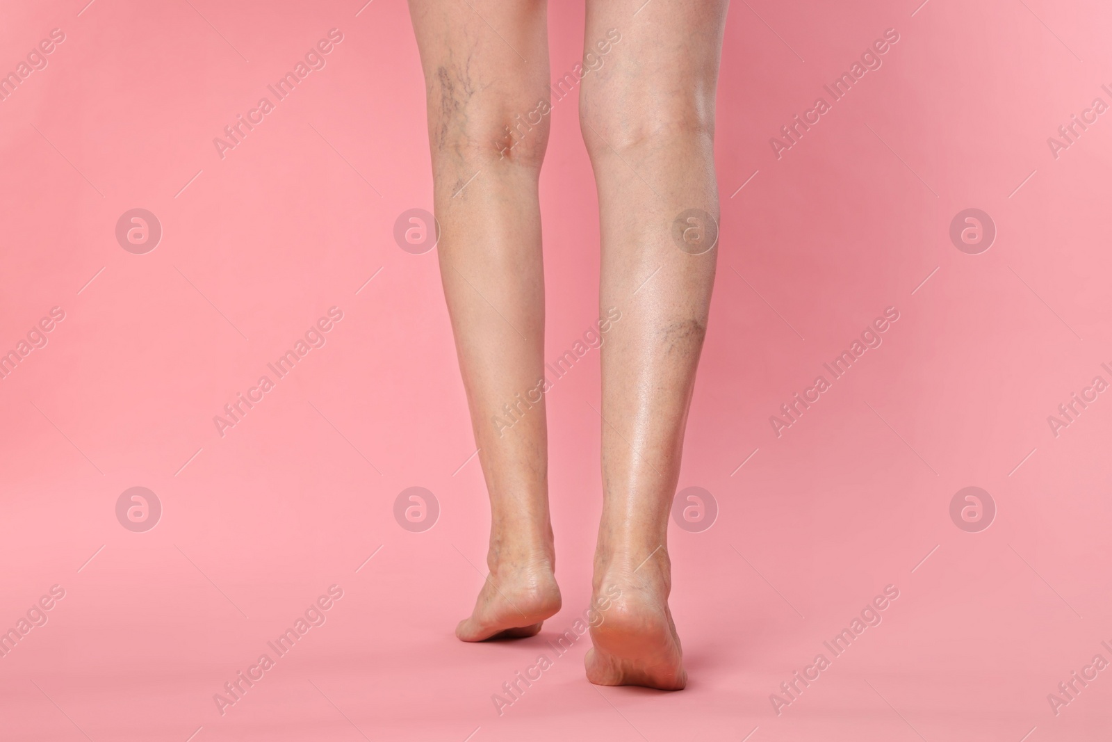 Photo of Closeup view of woman with varicose veins on pink background