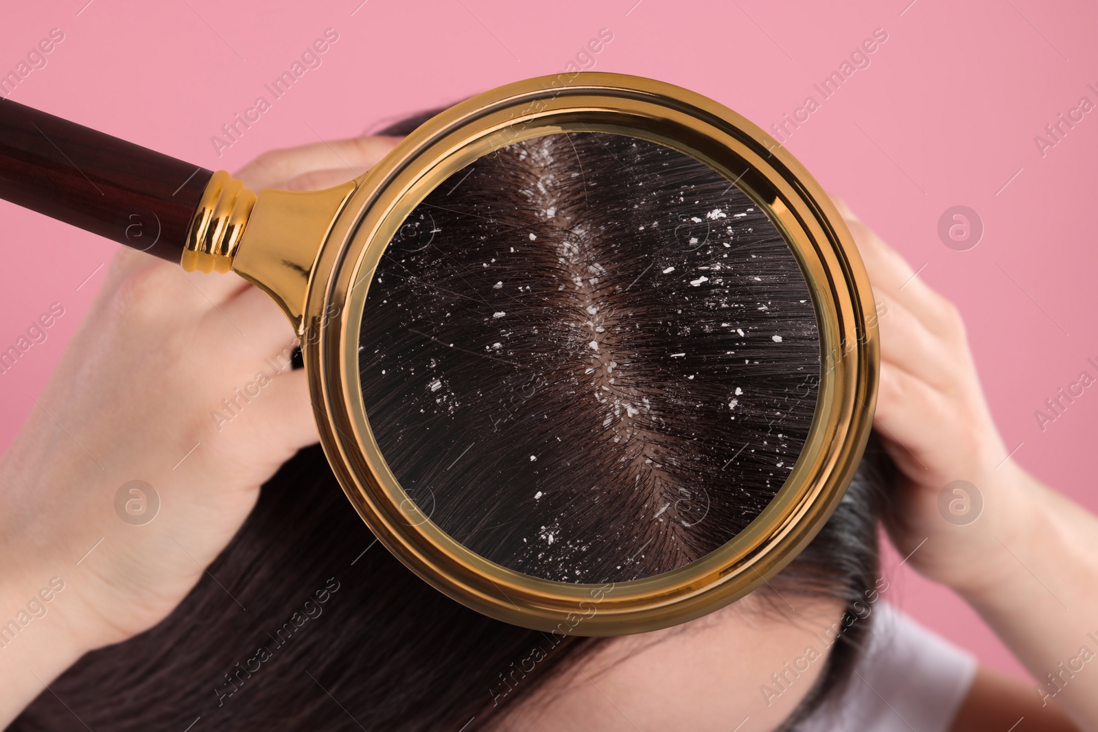 Image of Woman suffering from dandruff on pink background, closeup. View through magnifying glass on hair with flakes