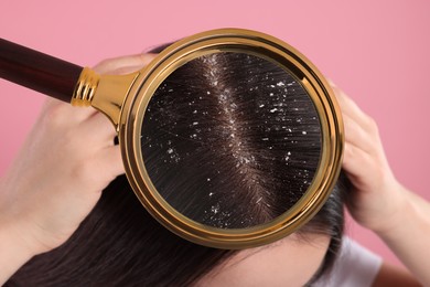Woman suffering from dandruff on pink background, closeup. View through magnifying glass on hair with flakes