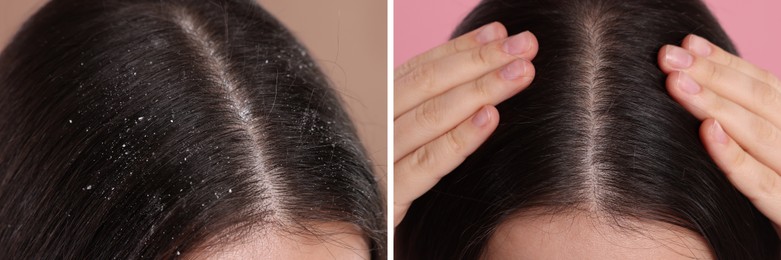 Image of Woman showing hair before and after dandruff treatment on color backgrounds, collage