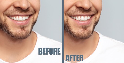 Image of Man before and after gingivoplasty procedure on light background, closeup. Banner design
