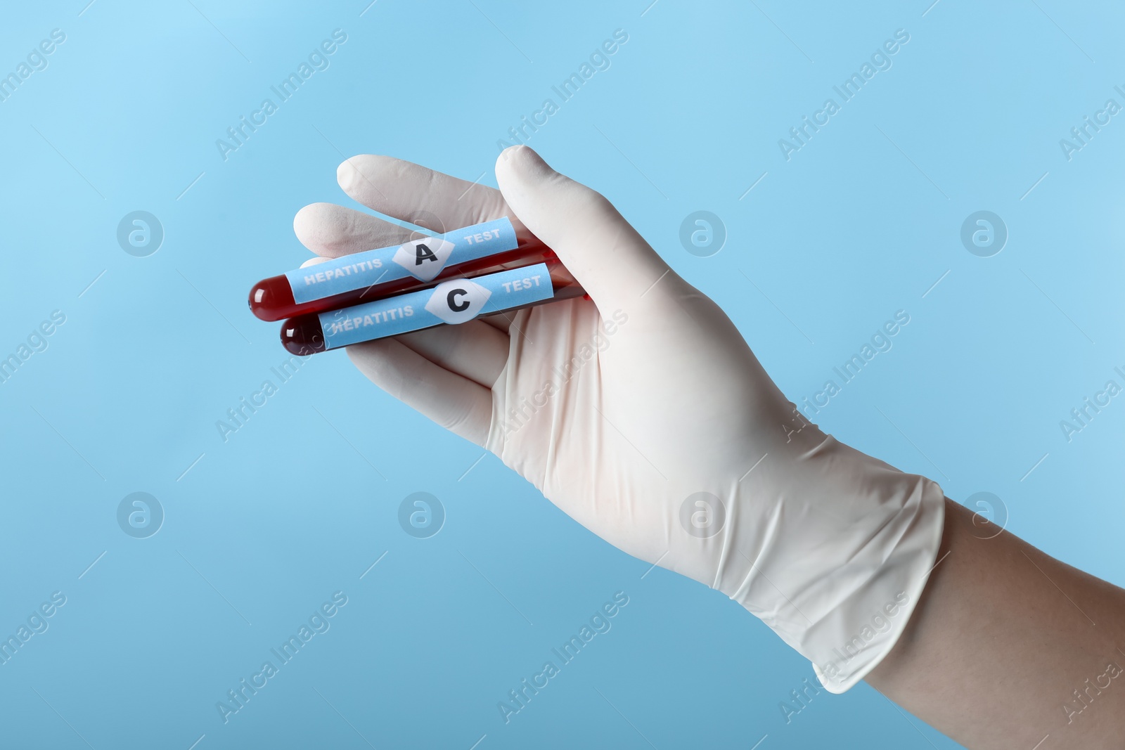 Photo of Scientist holding tubes with blood samples for hepatitis virus test on light blue background, closeup