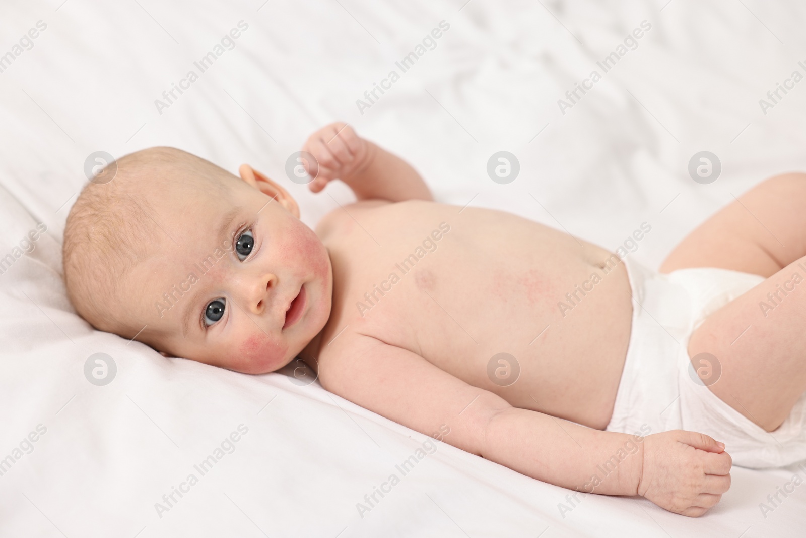 Photo of Cute little baby with allergic redness on cheeks lying on white blanket