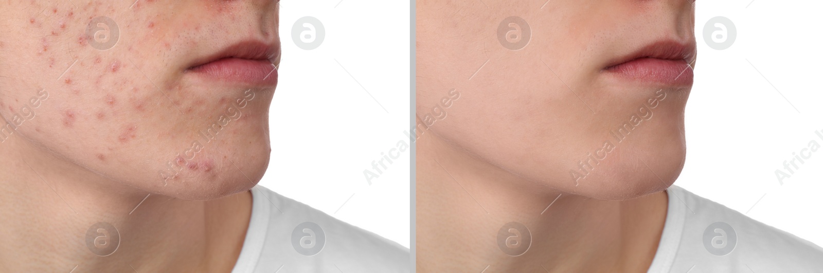 Image of Acne problem. Young man before and after treatment on white background, closeup. Collage of photos