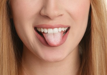Image of Young woman showing tongue with white patches, closeup. Oral candidiasis (thrush) disease