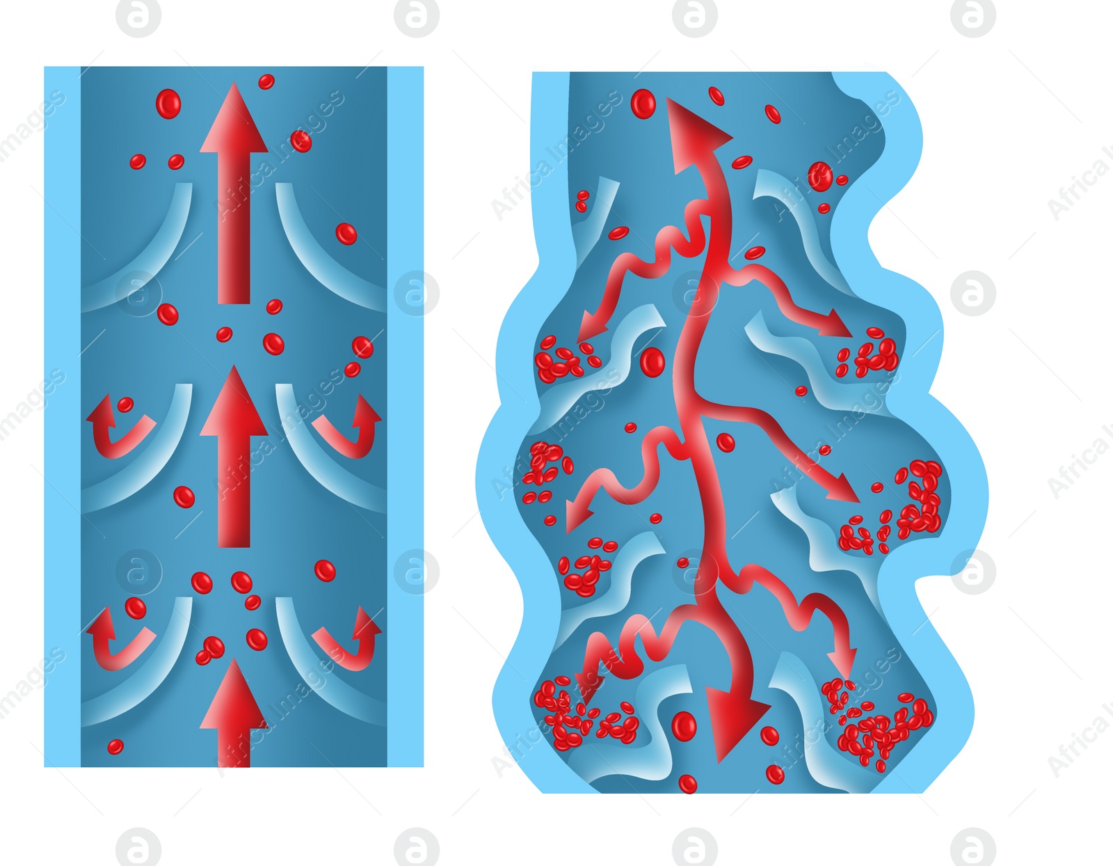 Illustration of Illustrations of damaged and healthy vein on white background, longitudinal section