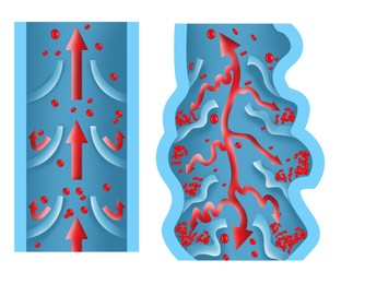 Illustration of Illustrations of damaged and healthy vein on white background, longitudinal section