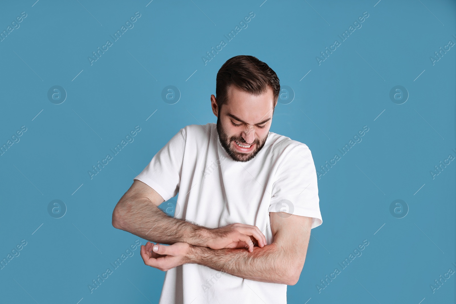 Photo of Young man scratching hand on color background. Allergies symptoms