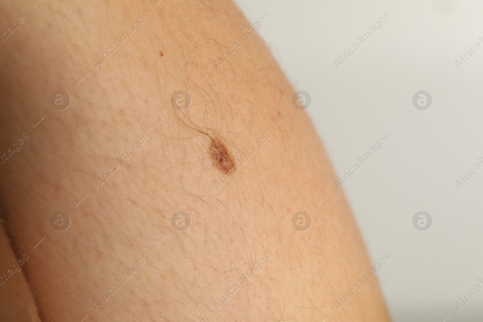 Photo of Closeup view of woman body with birthmark on grey background