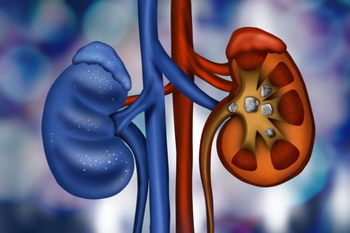 Illustration of  healthy and diseased kidneys on blue background
