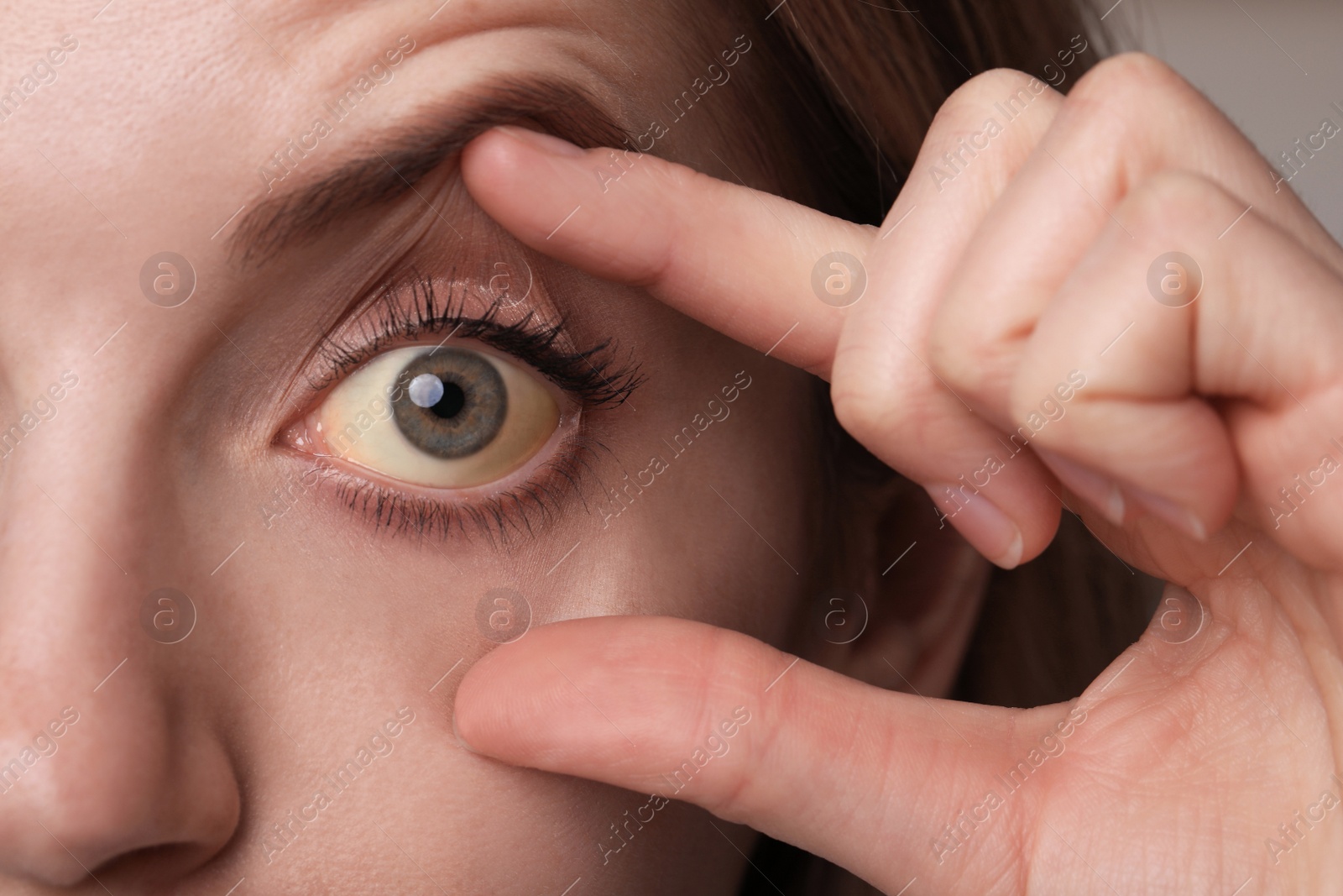 Photo of Woman checking her health condition, closeup. Yellow eyes as symptom of problems with liver