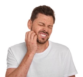 Image of Man with rash suffering from monkeypox virus on white background