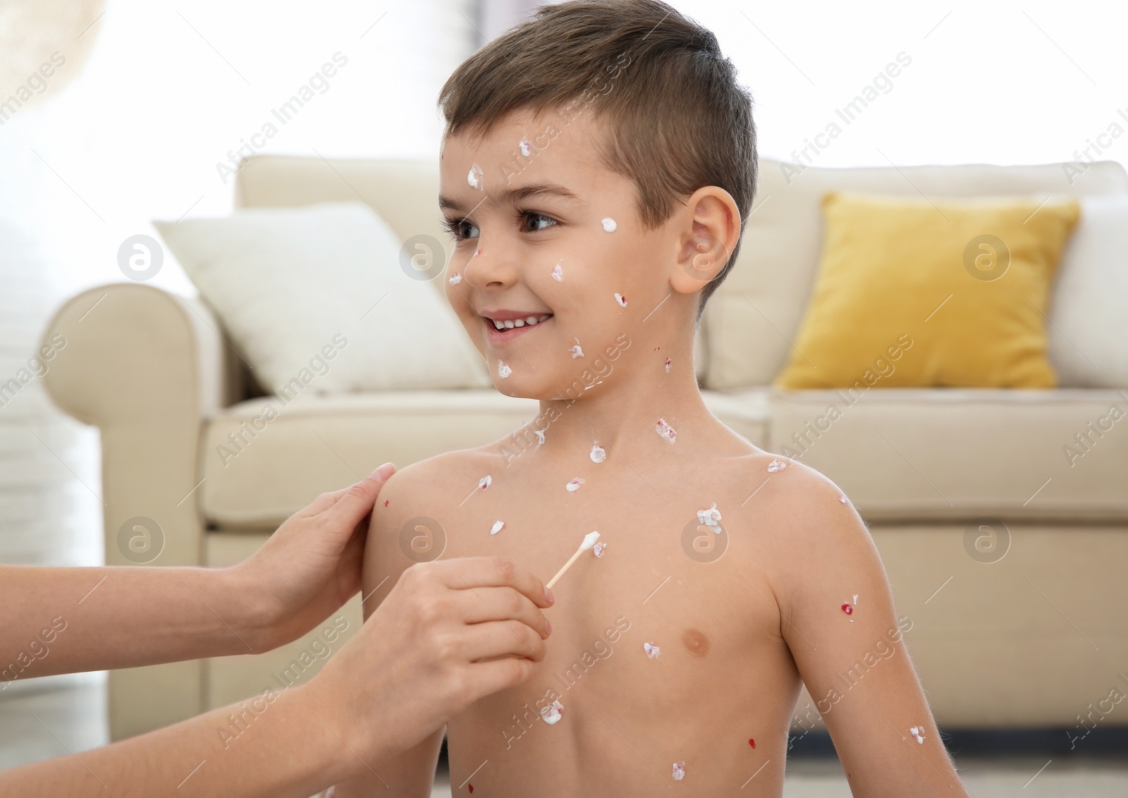 Photo of Woman applying cream onto skin of little boy with chickenpox at home