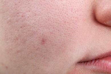 Photo of Woman with dry skin on face, closeup