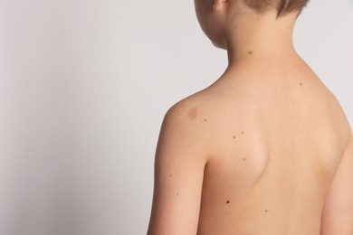Photo of Closeup of boy's body with birthmarks on light grey background, back view. Space for text