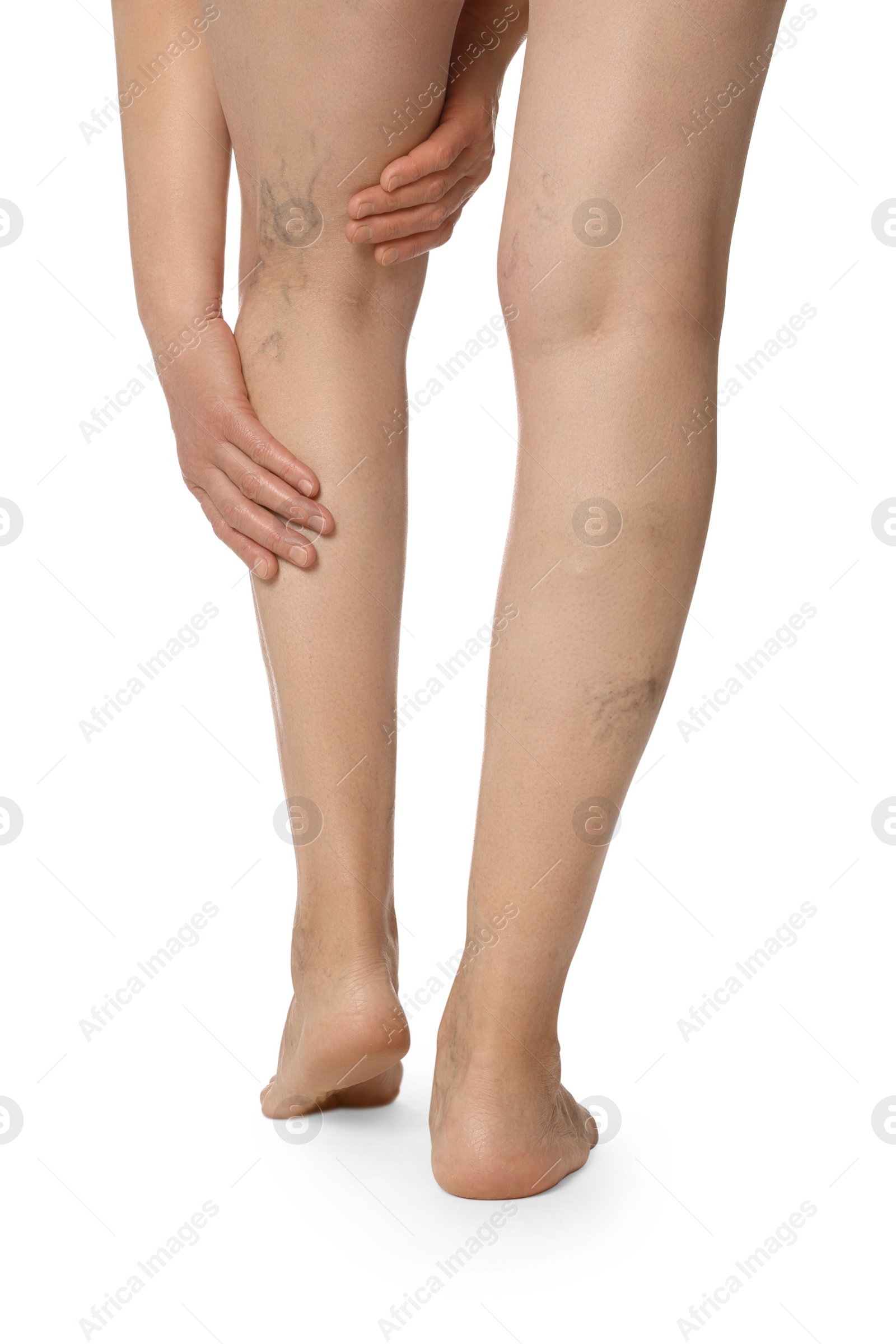 Photo of Closeup view of woman with varicose veins on white background