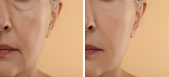 Aging skin changes. Woman showing face before and after rejuvenation, closeup. Collage comparing skin condition