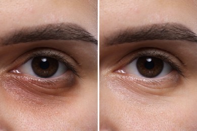 Collage with photos of woman with dark circle under eye before and after treatment, closeup