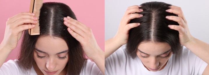 Woman showing hair before and after dandruff treatment on color backgrounds, collage