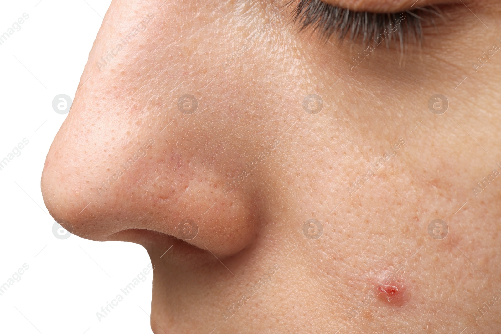 Photo of Young woman with acne problem on white background, closeup view of nose