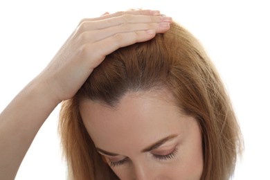 Photo of Woman suffering from baldness on white background, closeup