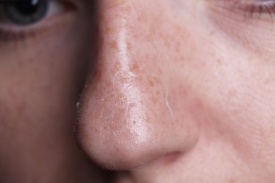 Photo of Woman with dry skin on nose, macro view