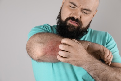 Man with allergy symptoms scratching forearm on grey background, closeup