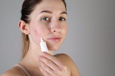 Photo of Young woman with acne problem applying cosmetic product onto her skin on light grey background. Space for text