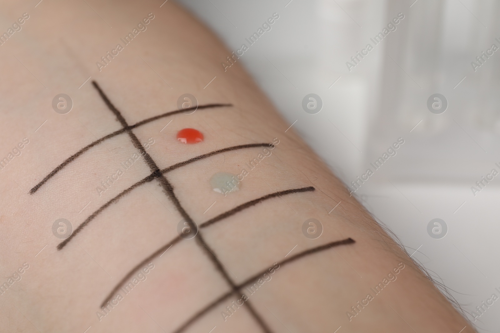 Photo of Patient undergoing skin allergy test at light table in clinic, closeup