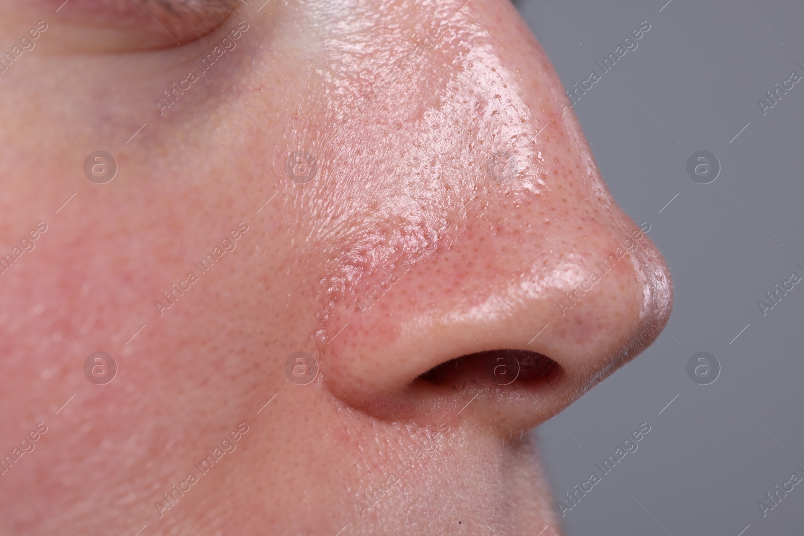 Photo of Closeup view of woman with reddened skin on grey background