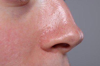 Photo of Closeup view of woman with reddened skin on grey background