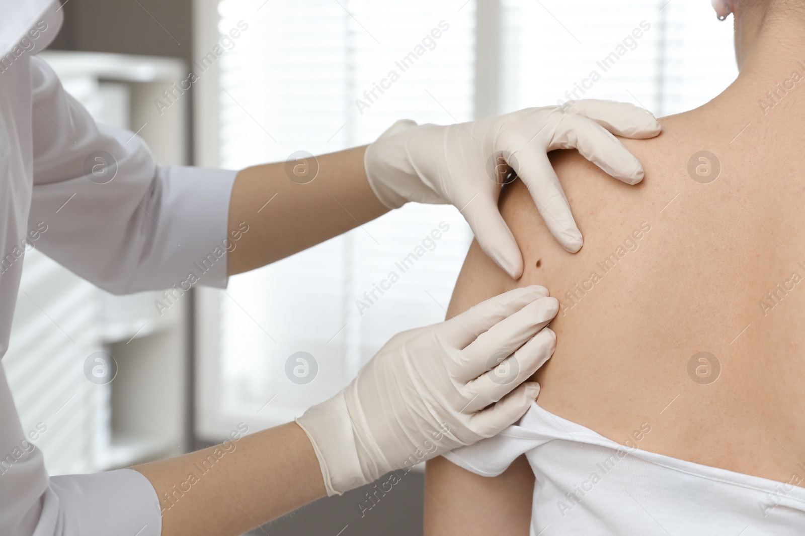 Photo of Dermatologist examining patient's birthmark in clinic, closeup view