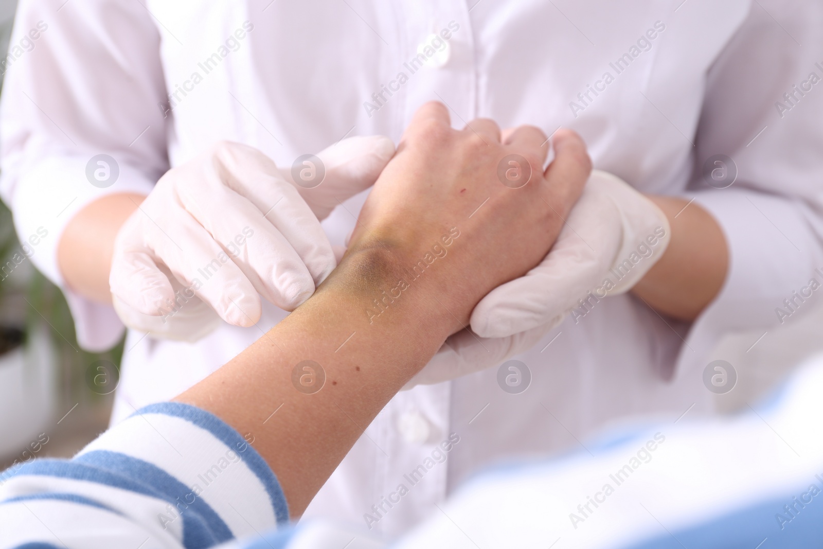 Photo of Doctor checking woman's wrist with bruise at hospital, closeup