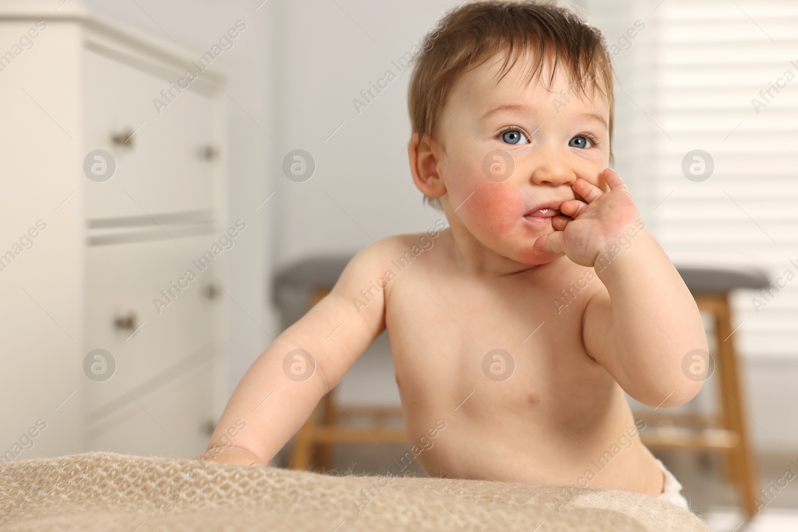 Photo of Cute little baby with allergic redness on cheeks indoors