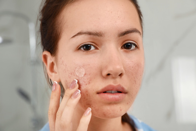 Teen girl applying acne healing patch indoors, closeup