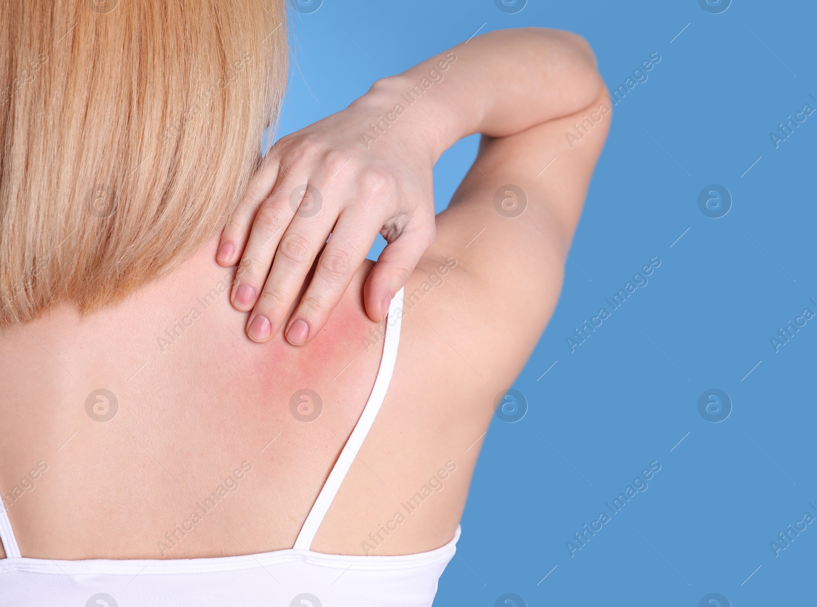 Photo of Woman with allergy symptoms scratching shoulder on color background, closeup. Space for text
