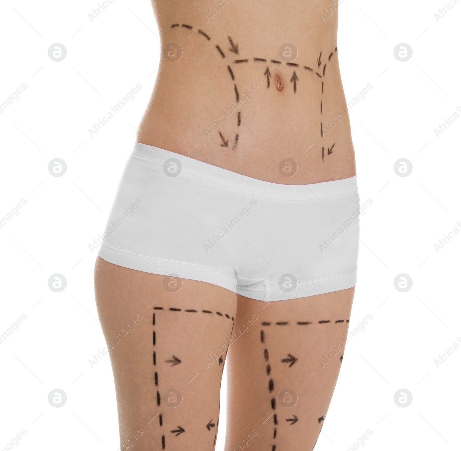 Photo of Young woman with marks on belly and legs for cosmetic surgery operation against white background