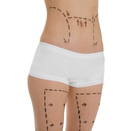 Young woman with marks on belly and legs for cosmetic surgery operation against white background