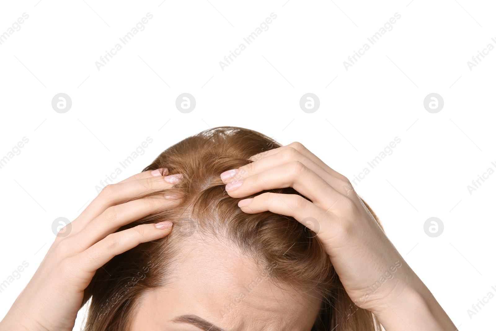 Photo of Young woman with hair loss problem on white background