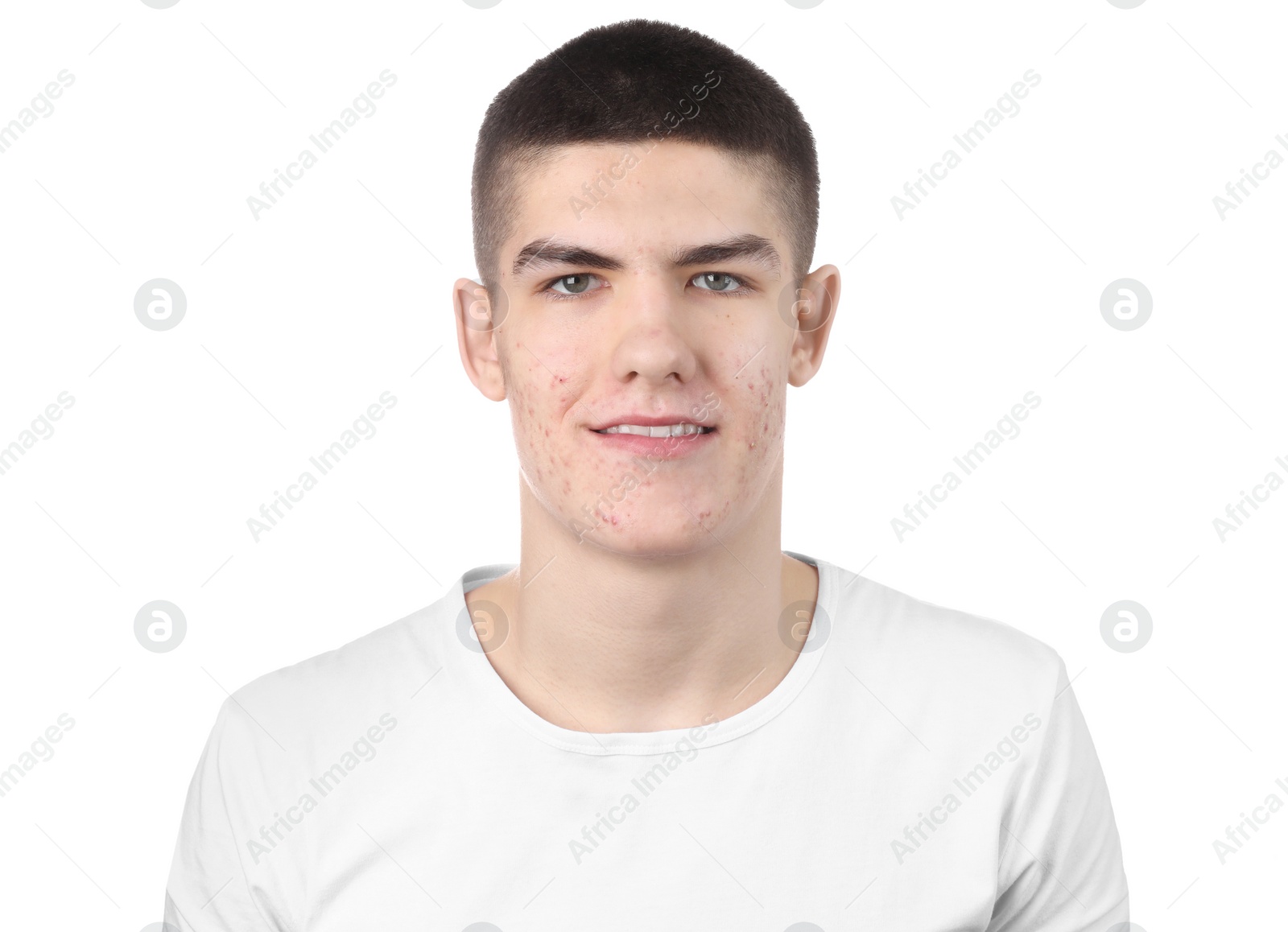 Photo of Young man with acne problem isolated on white