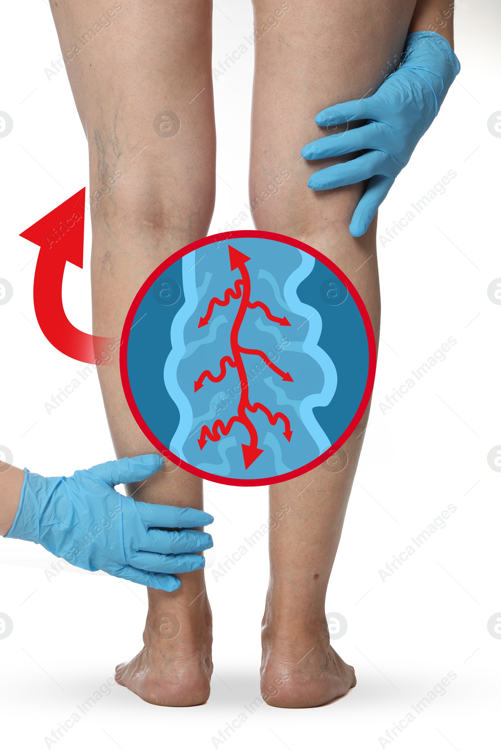 Image of Doctor examining patient with varicose veins on legs against white background, closeup. Illustration of damaged vein, longitudinal section