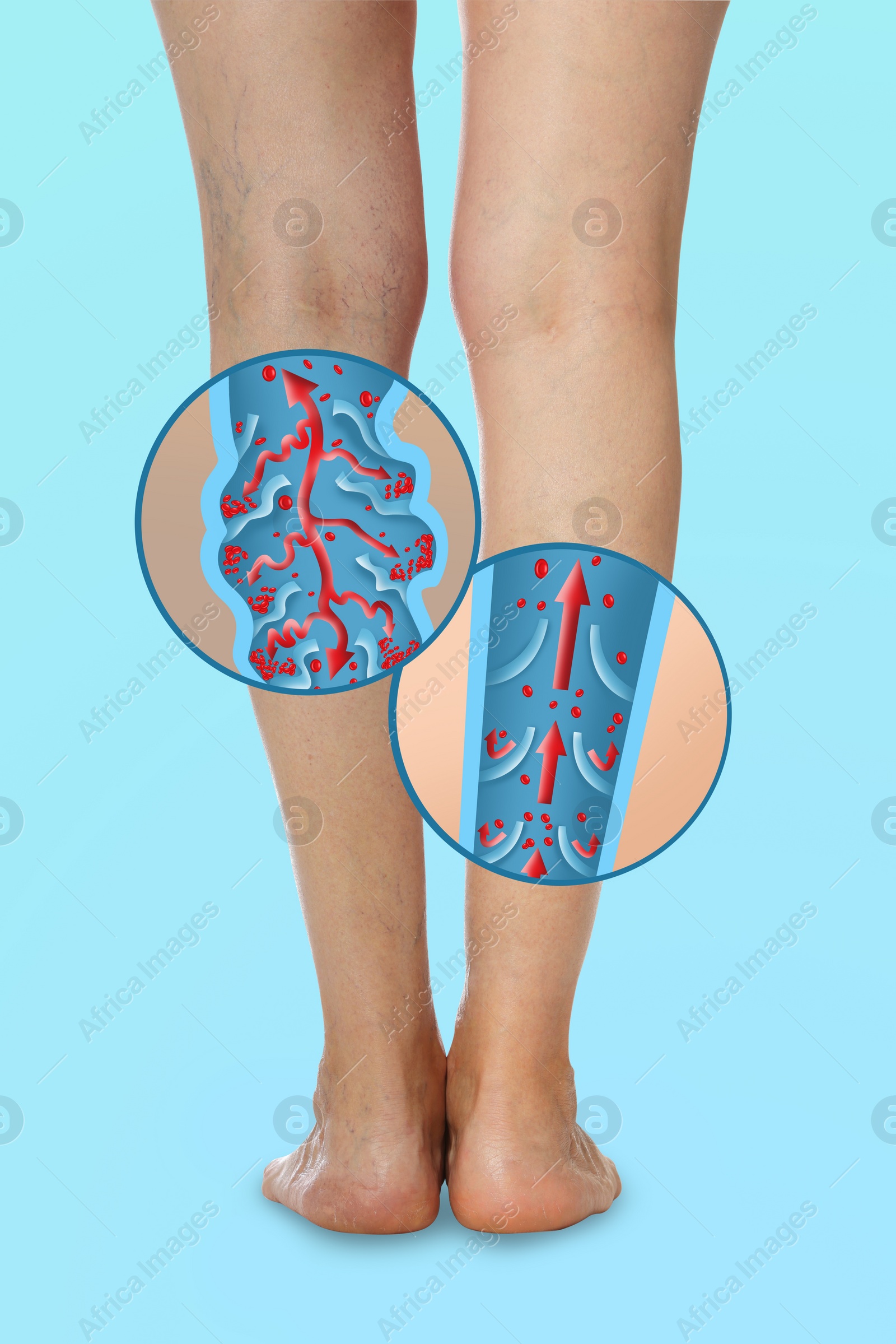 Image of Closeup view of woman with varicose veins on light blue background. Illustrations of damaged and healthy vein on white background, longitudinal section