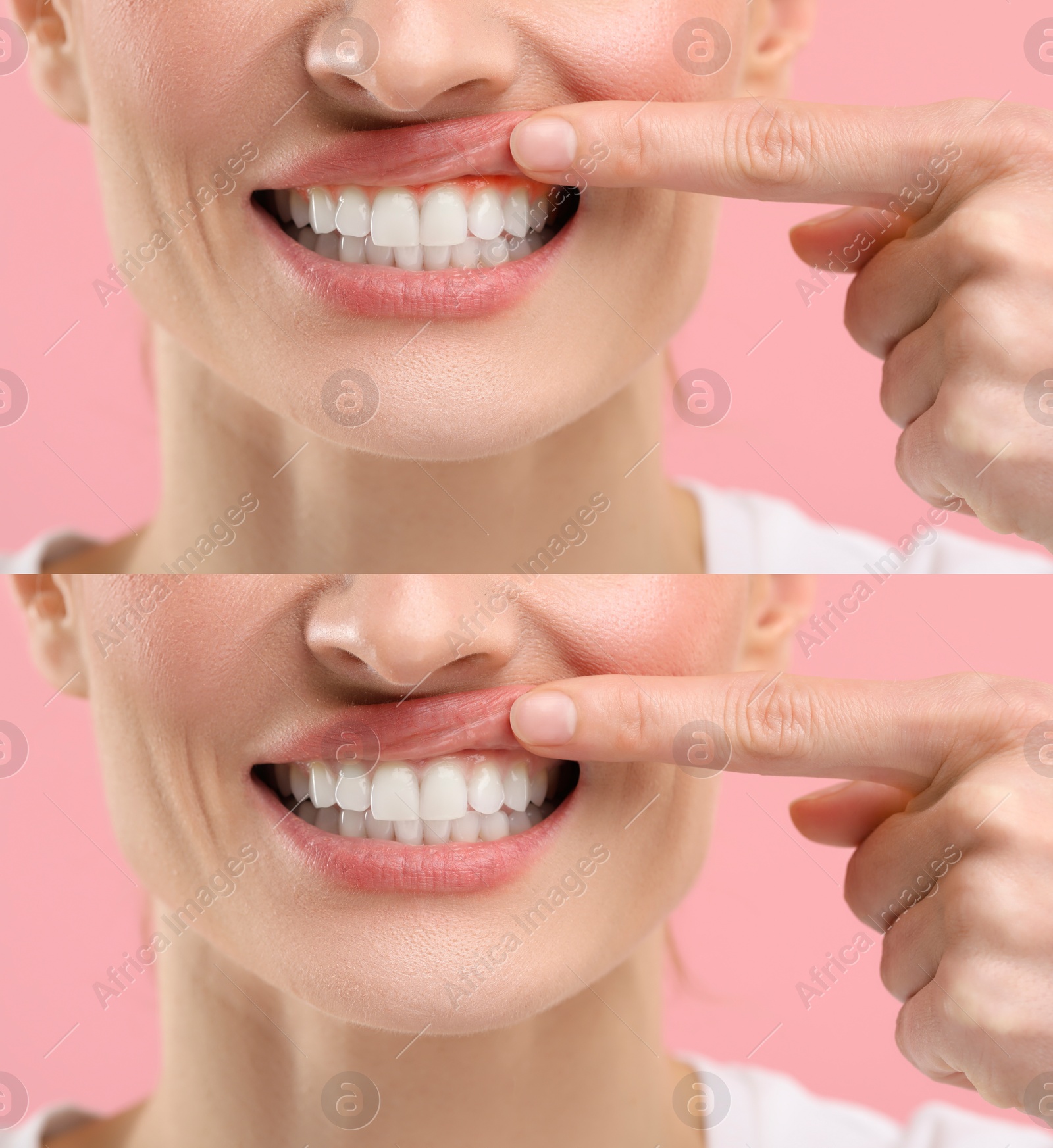 Image of Woman showing gum before and after treatment on pink background, collage of photos