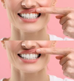 Image of Woman showing gum before and after treatment on pink background, collage of photos