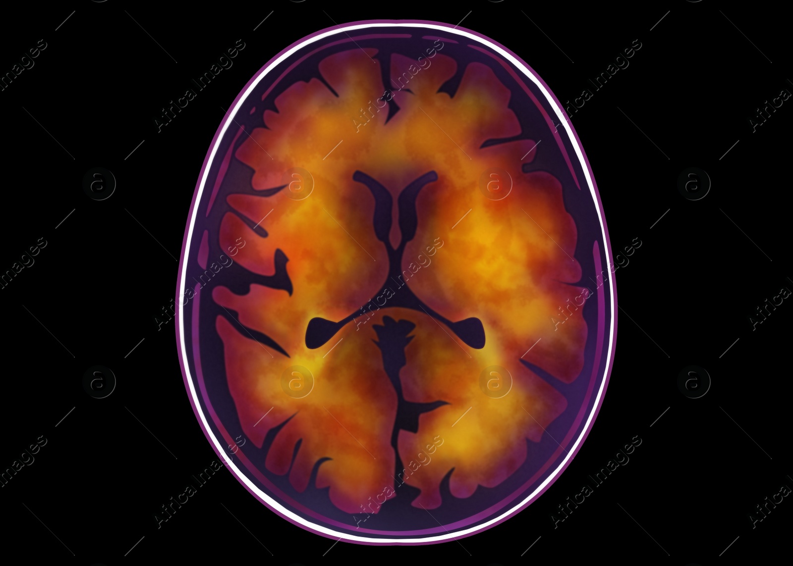 Illustration of Scan of injured human brain with injured area on black background, illustration