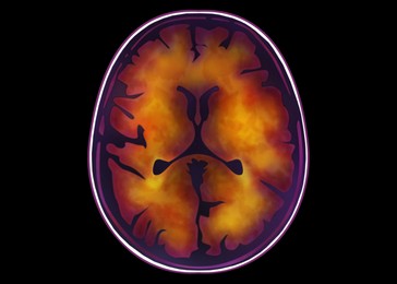 Illustration of Scan of injured human brain with injured area on black background, illustration