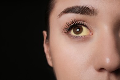 Photo of Woman with yellow eyes on black background, closeup and space for text. Liver problems symptom