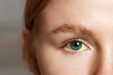 Woman with yellow eyes on blurred background, closeup. Symptom of hepatitis